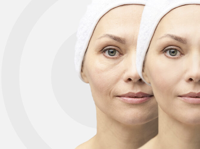 Intradermis Revitalizante: Mesoterapia de Vitaminas zona periocular